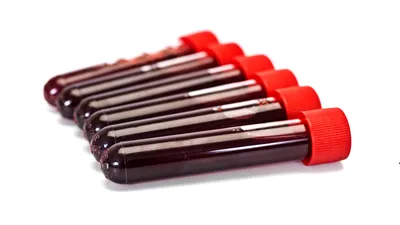 17-hydroksyprogesteron